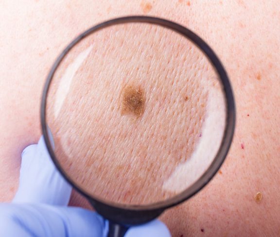 how-to-spot-this-potentially-deadly-skin-cancer-future-of-personal-health