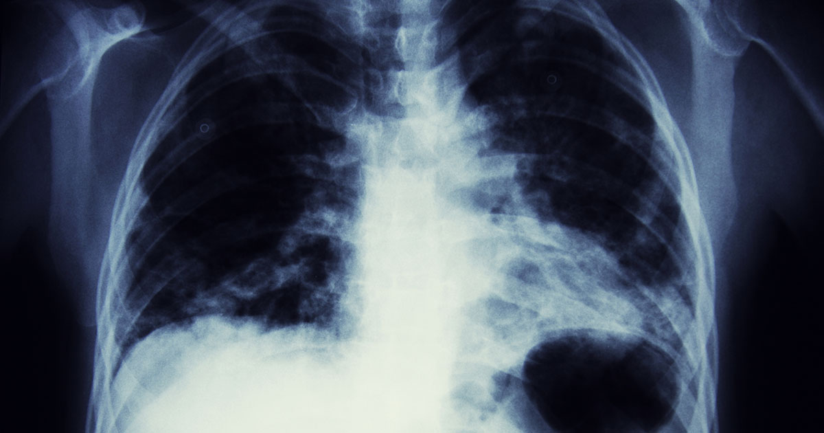 Screening for Lung Cancer Can Save Lives - Future of Personal Health