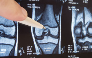 elective joint replacement-healthcare-broken bone-orthopedic surgery