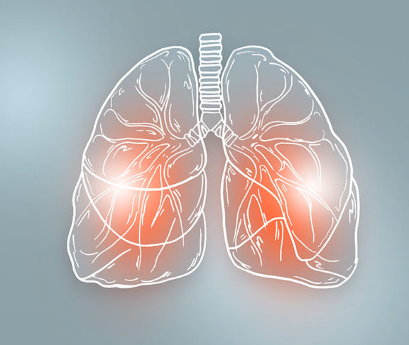 idiopathic pulmonary fibrosis-IPF-disease