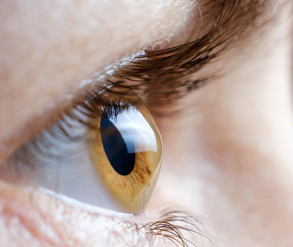keratoconus-eye-contact lens-