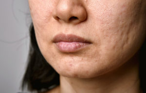 Acne scars-dermatologist-scarring-acne-collagen