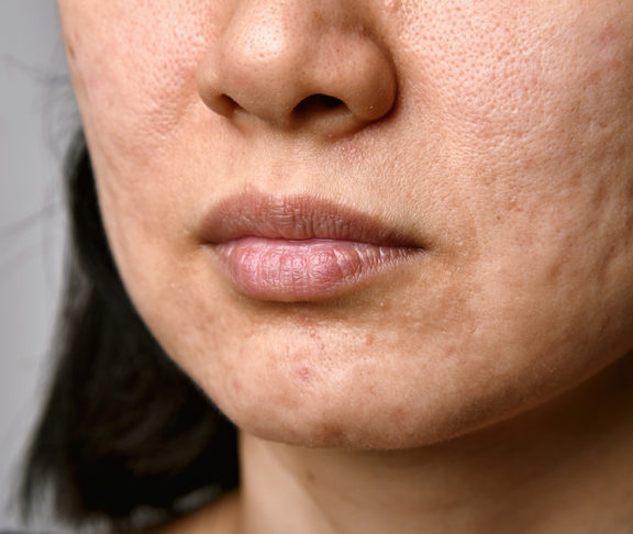 Acne scars-dermatologist-scarring-acne-collagen
