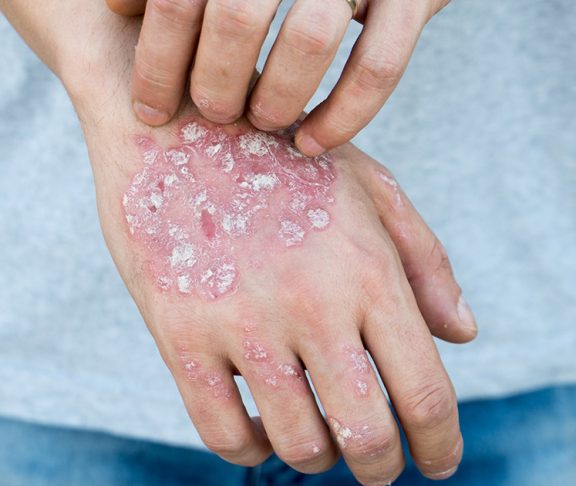 A person with psoriasis scratching their inflamed hand