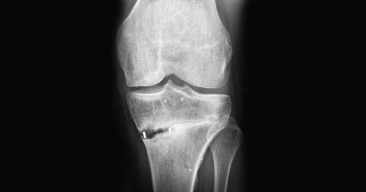 X-ray of a knee after surgery