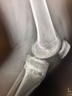X-ray of a bent knee after surgery