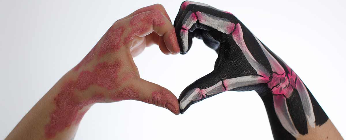 Two hands form a heart, one painted with psoriasis and one painted with joints