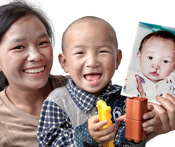 A lady and her child posing after a successful cleft surgery