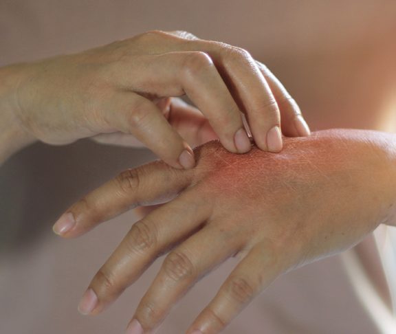 skin itching eczema