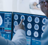doctors examining brain scan