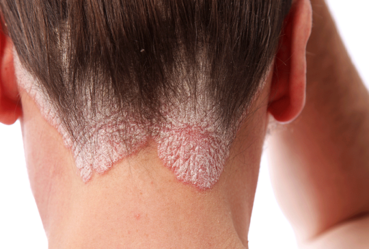 psoriasis skin condition on neck