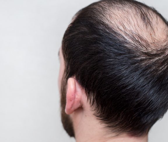 Mesotherapie in der Ästhetischen Medizin und zur Bekämpfung des Haarausfalls
