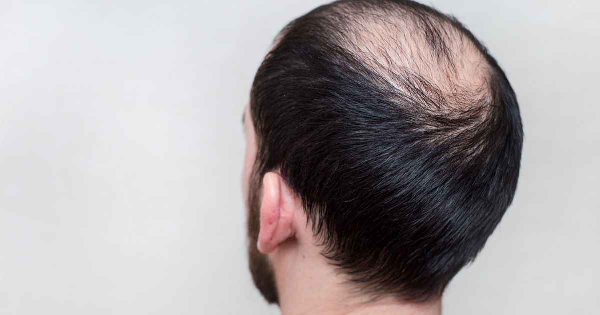 Mesotherapie in der Ästhetischen Medizin und zur Bekämpfung des Haarausfalls