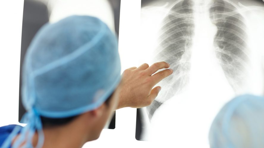Closeup of a doctor's hand pointing to a patient's chest and lung x-ray