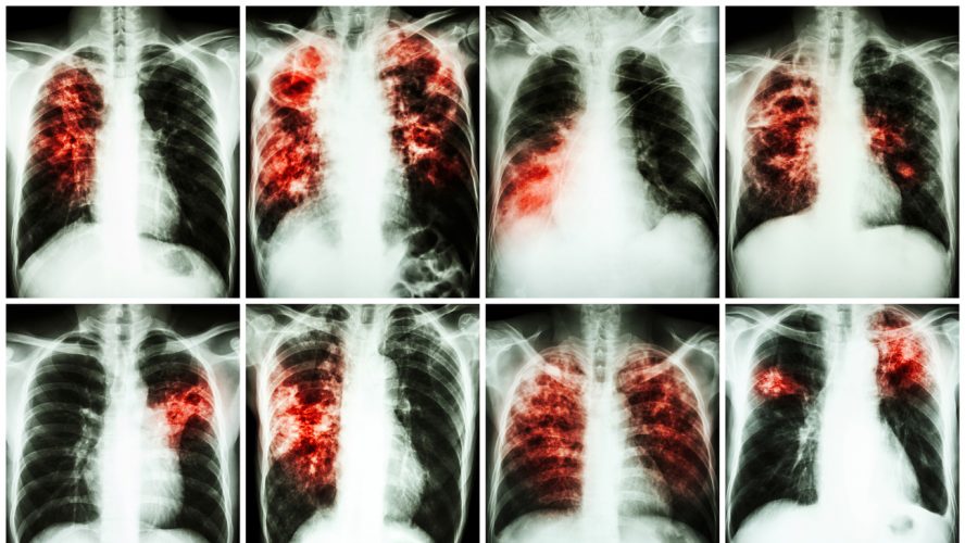 Photos of pulmonary tuberculosis