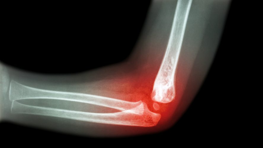 Rheumatoid arthritis , Gouty arthritis