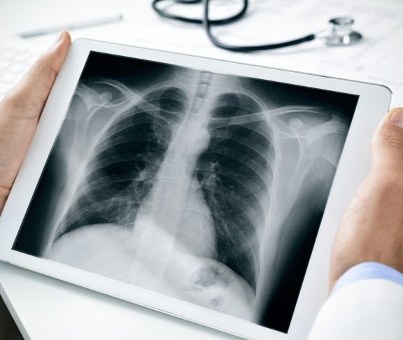 doctor observing a chest radiograph in a tablet