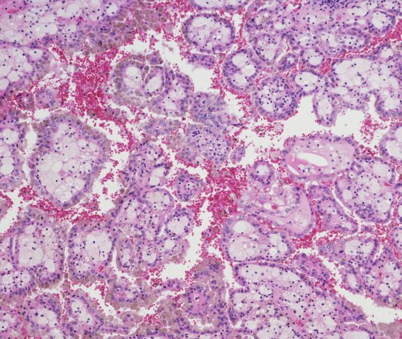 Micrograph of Renal Cell Carcinoma (RCC)