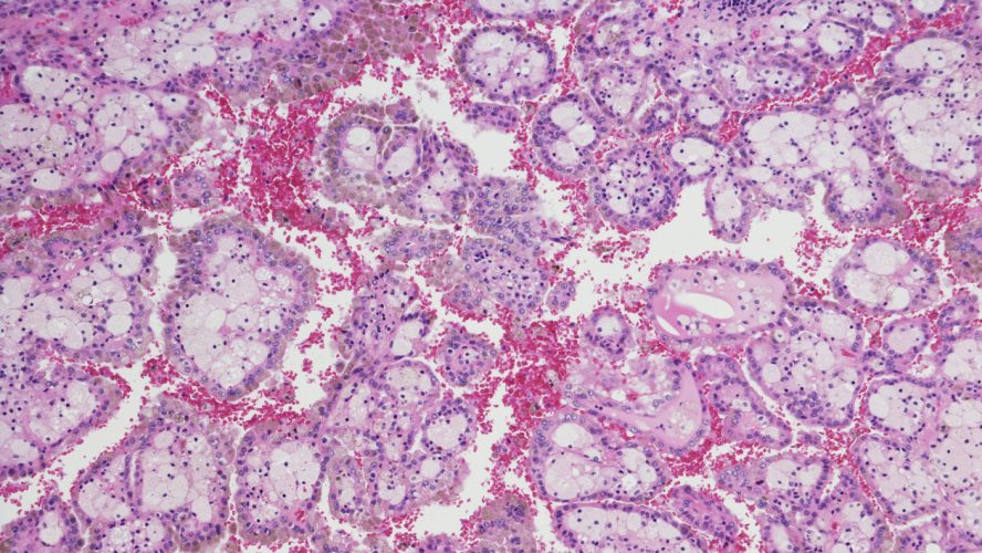 Micrograph of Renal Cell Carcinoma (RCC)