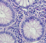 Colon cancer microscopic photography, magnification x400