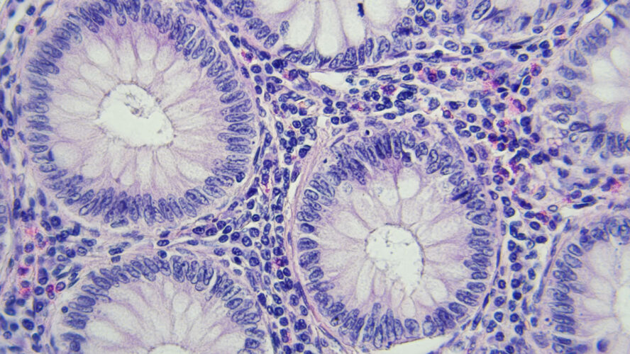 Colon cancer microscopic photography, magnification x400