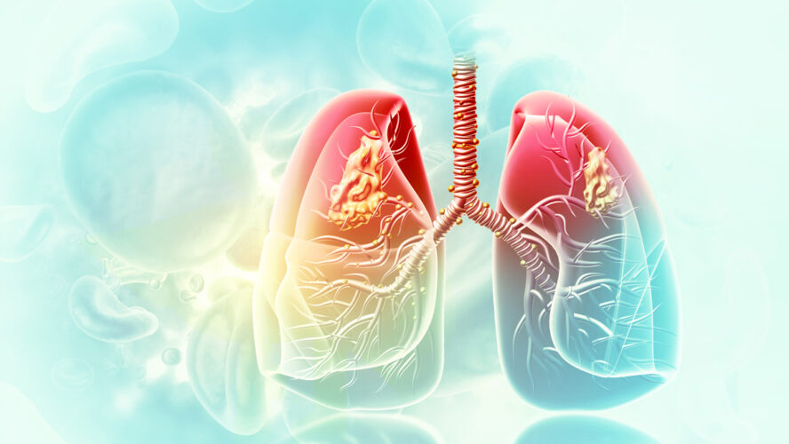 Medical Illustration showing lung cancer or bronchial carcinoma. 3d illustration