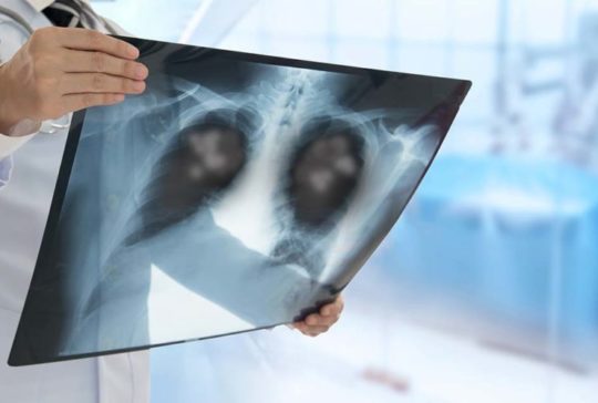 lung-cancer xray