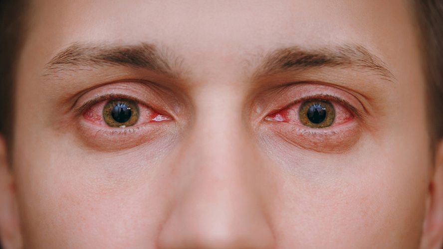 Allergi kan være livstruende