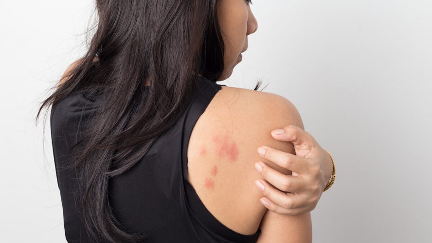 kvinde har Symptomer på kontaktallergi på ryggen