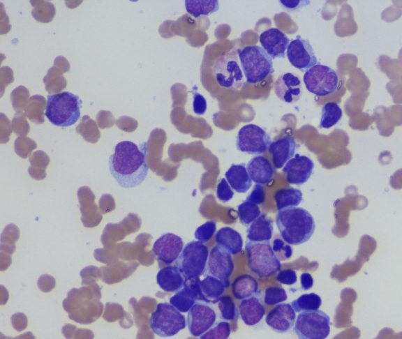 Micrograph of myeloma neoplasm bone marrow aspirate. Wright Giemsa Stain
