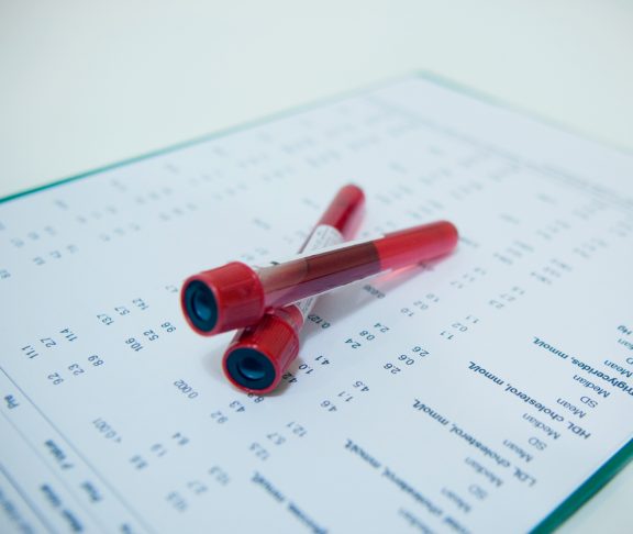 Hematology blood analysis report with lavender color blood sample collection tubes.
