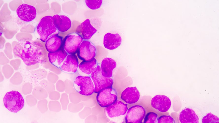 blood smear is often used as a follow-up test to abnormal results on a complete blood count (CBC) to evaluate the different types of blood cells.Medical science background showing blast cells(AML)
