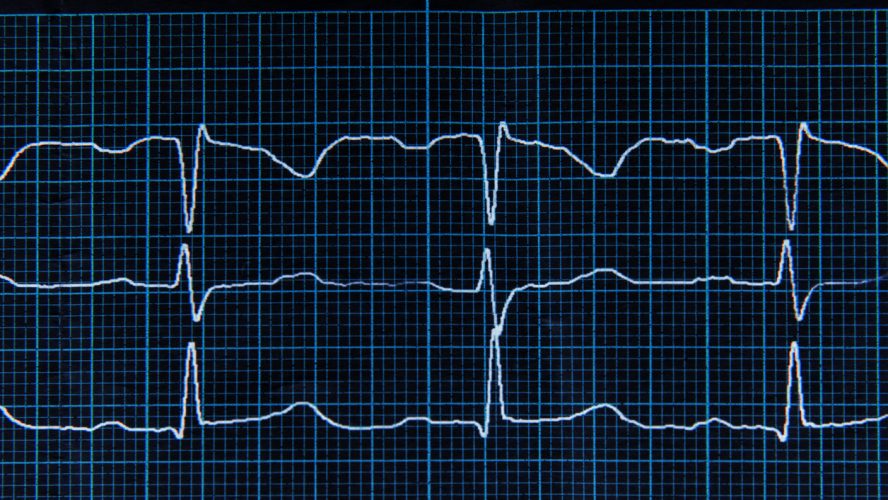 Close up. Normal ECG with arrhythmia elements. The heartbeat lines on the monitor screen are blue.