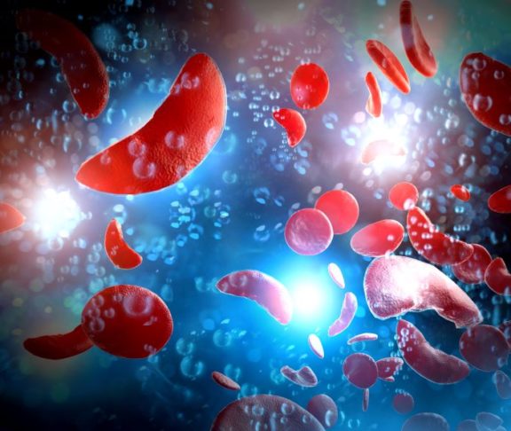 Bei der Sichelzellkrankheit verformen sich die roten Blutkörperchen zu sichelförmigen Zellen.