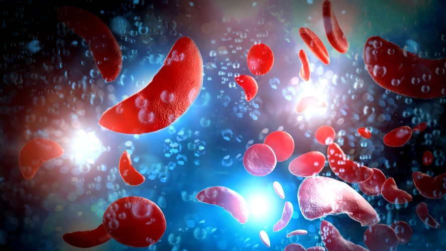 Bei der Sichelzellkrankheit verformen sich die roten Blutkörperchen zu sichelförmigen Zellen.