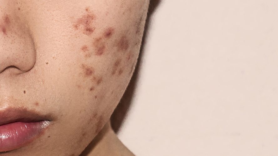Close-upfoto van persoon met acne in het aangezicht