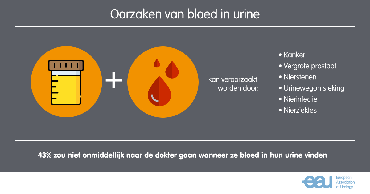 Oorzaken van bloed in urine: kanker, vergrote prostaat, nierstenen, urinewegontsteking, nierinfectie, nierziektes