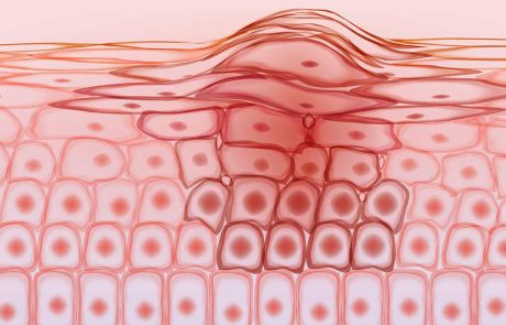 Grafische afbeelding huidkankercellen